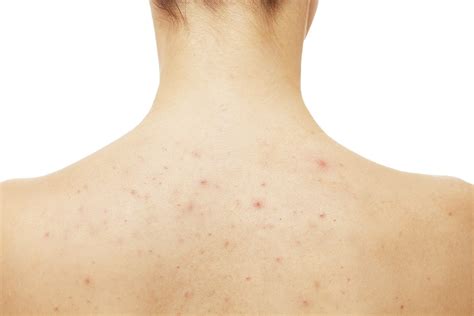 Back Acne And How To Treat It Buckhead Dermatology