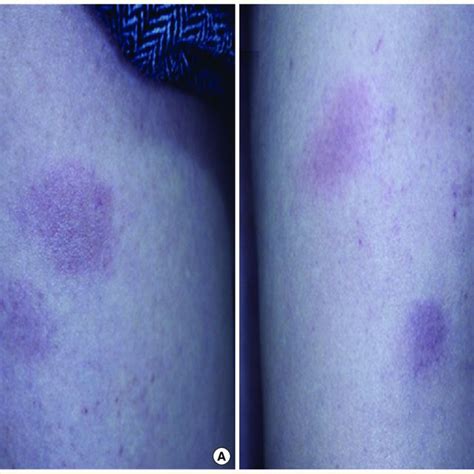 Multiple Erythematous Nodules At The Site Of Insulin Injection A