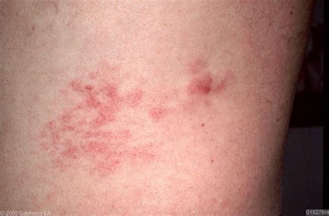 Early Cutaneous T Cell Lymphoma Rash