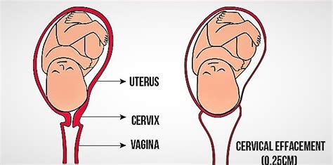 What Does Posterior Cervix Mean In Pregnancy Pregnancywalls