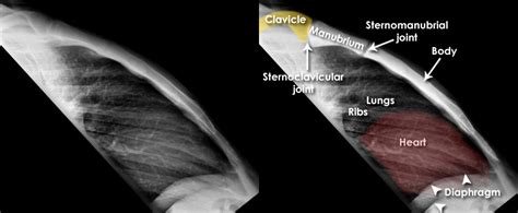 Trauma X Ray Axial Skeleton Sternum
