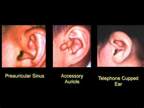 Ppt Diseases Of External Ear Powerpoint Presentation Free Download
