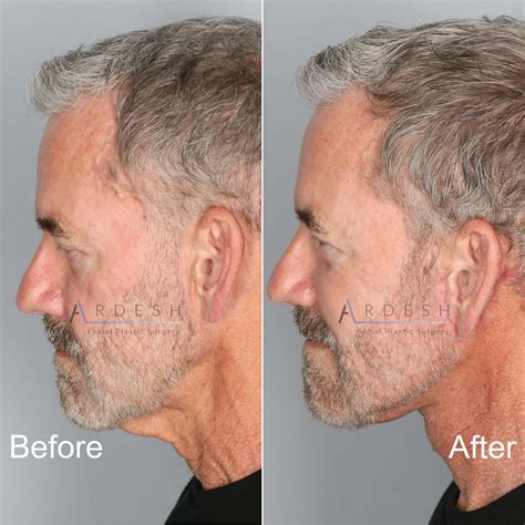 Neck Lift Before And After Ardesh Facial Plastic Surgery