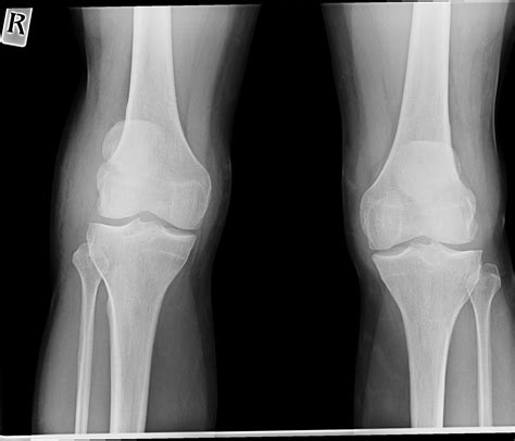 Spontaneous Simultaneous Bilateral Patellar Tendon Rupture Bmj Case