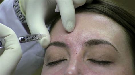 Botox Injection Technique For Wrinkle Reduction In Virginia Youtube