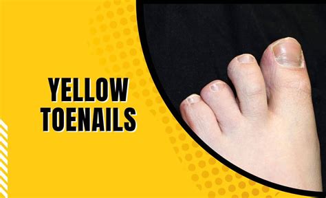 Yellow Toenails Causes Prevention And Treatments Resurchify