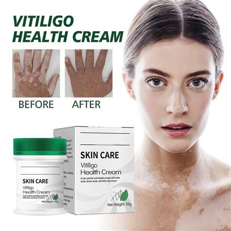 Crème De Vitiligo Traitement Du Vitiligo Pour La Peau Vitiligo Crème