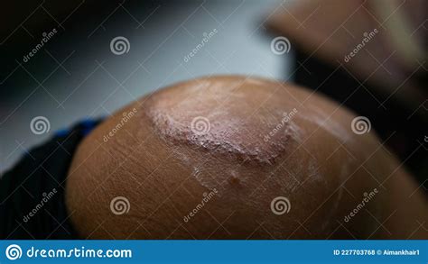 Circle Ringworm With Medical Treatment Cream Is Applied On The Patient