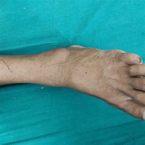 Clinical Photograph Of Left Ankle Showing Swelling Below Lateral