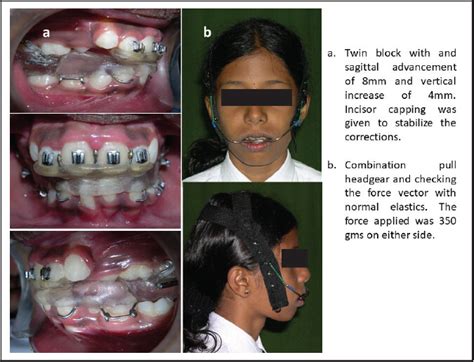 Multistage Treatment Of A Class Ii Division 1 Malocclusion With Severe