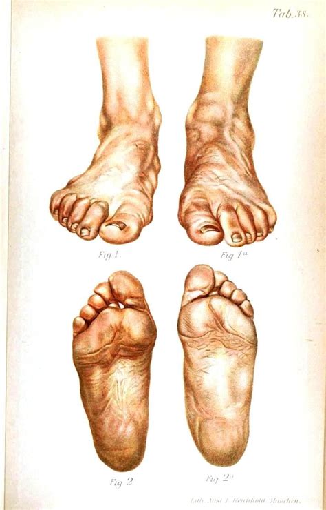 Framed Vintage Medical Print U00 The Human Foot Picture Pathology