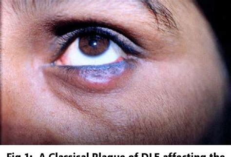 Figure 1 From Discoid Lupus Erythematosis Affecting The Eyelid With