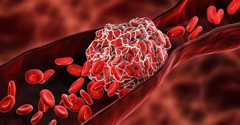 Blood Clot Causes Symptoms And Treatment Options