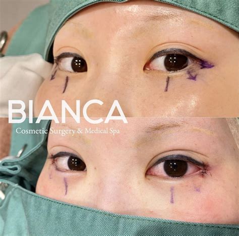 Eye Slant Reduction Surgery Reshape Eyes By Lowering The Outer Eye Corner Trambellir