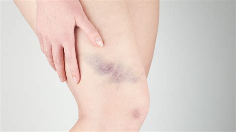 What Does It Mean When You Bruise Easily