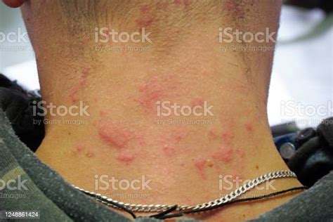 Red Skin Rash On The Neck Allergic Reaction On Skin Stock Photo