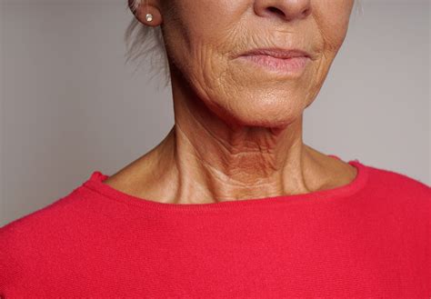 Ageing Neck Alisha Louise Aesthetics Skelmersdale