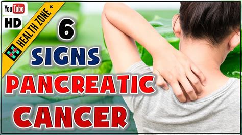 6 Early Signs Of Pancreatic Cancer Symptom Of Pancreatic Cancer Youtube