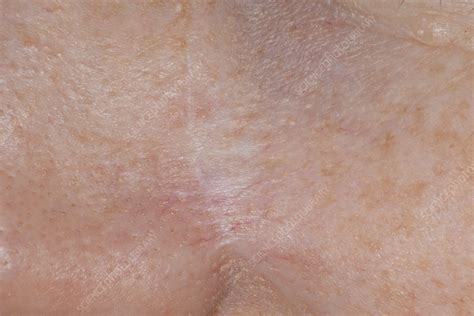 Basal Cell Carcinoma Scar Stock Image C0498739 Science Photo Library