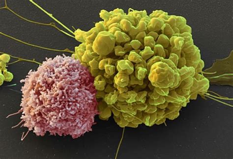 Natural Killer Cells For Prostate Cancer Immunotherapy Prostate