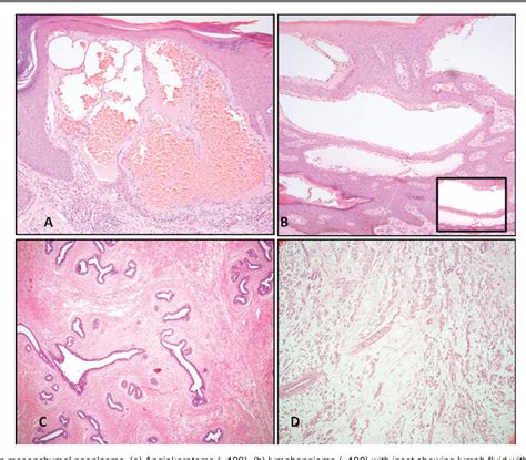 Figure 5 From Histopathologic Spectrum Of Vulvar Lesions In South India