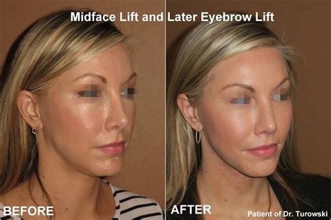 New Horizons Plastic Surgery Midface Lift And Lateral Eyebrow Lift