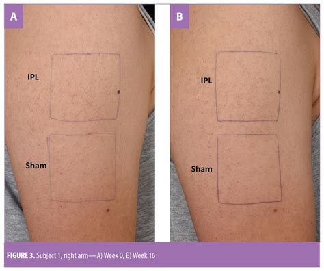 Intense Pulsed Light Therapy Significantly Improves Keratosis Pilaris