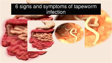6 Signs And Symptoms Of Tapeworm Infection Youtube
