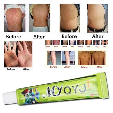 15gbox Hot Sell Skin Psoriasis Cream Dermatitis Eczematoid Eczema Ointment Treatment Psoriasis