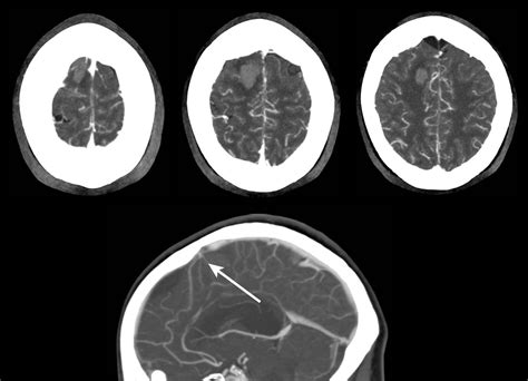 Investigating Intracerebral Haemorrhage The Bmj