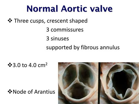 Ppt Echocardiographic Assessment Of Aortic Valve Stenosis Powerpoint