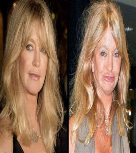 Of The Worst Celebrity Plastic Surgery Disasters