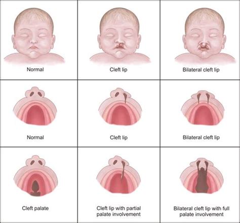 Fetus Causes Of Cleft Chin And Palate Photos Of Cleftlip And Palate