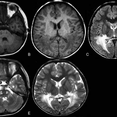Brain MRI Of The Patient Decreased Signal Was Observed Of The White