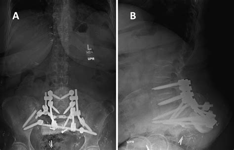 Compassionate Use Of A Custom 3d Printed Sacral Implant For Revision Of