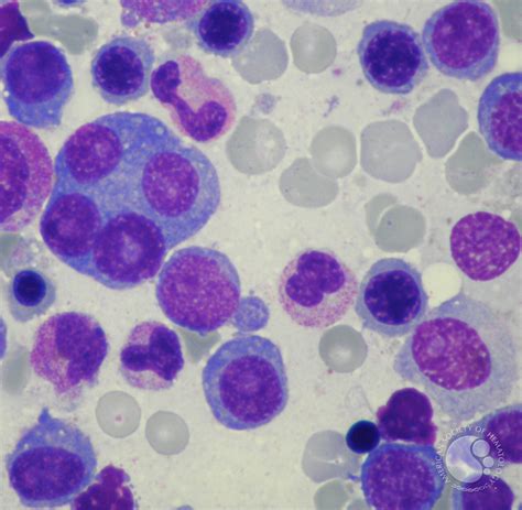 Four Nucleate Plasma Cell In Multiple Myeloma 1