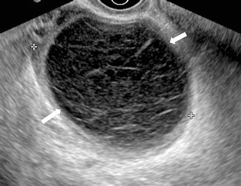 Corpus Luteum Cyst Ultrasound