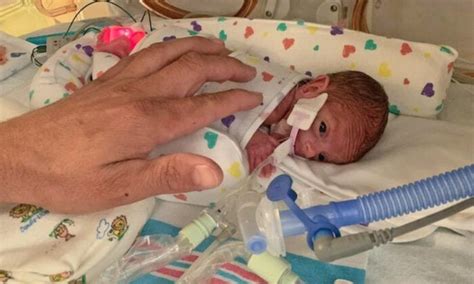 One Pound ‘micro Preemie Born At 22 Weeks Goes Home After 133 Days In