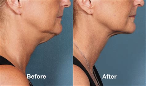 The Importance Of Neck Lift Without Surgery