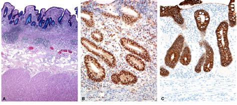 Ulcerative Colitis A Distorted Crypt Architecture Inflammation In