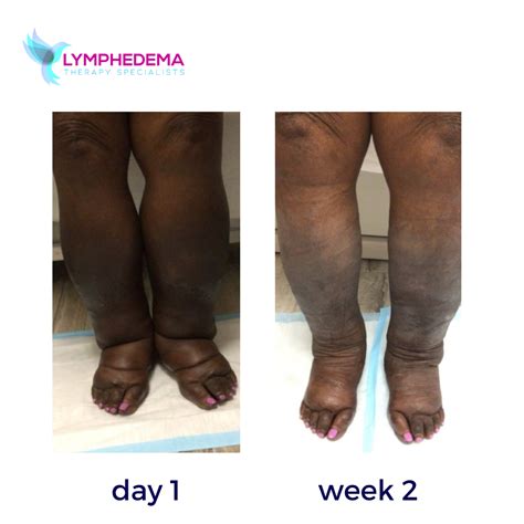 Before And After Lymphedema Therapy Specialists