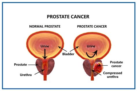 Prostate Cancer Symptoms Causes Diagnosis Treatment