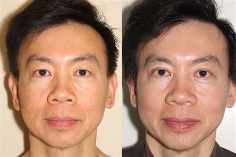 Before And After Asian Double Eyelid Surgery Dr Andrew B Denton