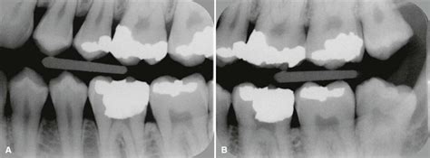 18 Dental Caries Pocket Dentistry