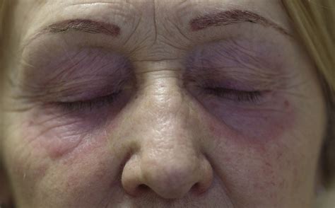 Rare Cause Of Periorbital And Eyelids Lesions Discoid Lupus