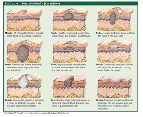 Skin Lesions Types Causes And Treatment For Skin1righ