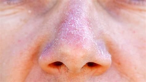 Skin Concerns Nose Constantly Peeling Skin Skincareaddiction