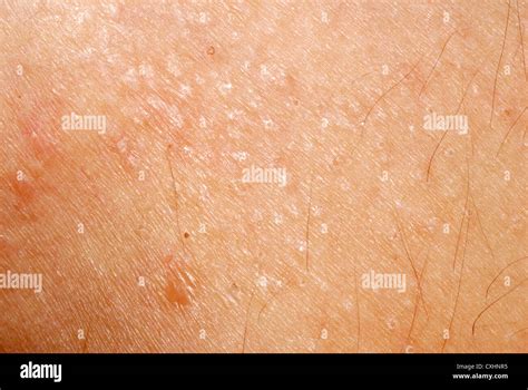 Erupción Dermatitis Alérgica La Textura De La Piel Fotografía De Stock