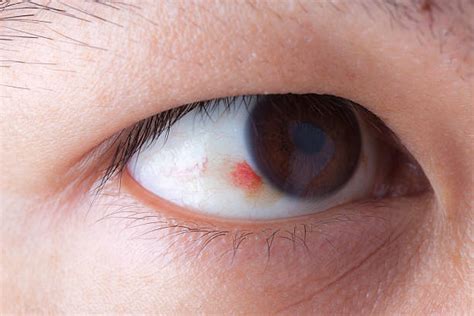 Conjunctival Hemorrhage Stock Photos Pictures And Royalty Free Images