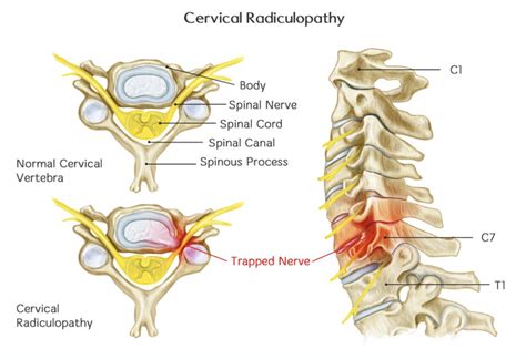 Cervical Nerve Roots Exit Above